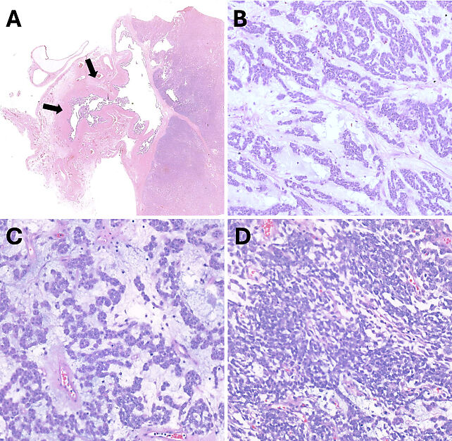 Pathology of Ovarian, Fallopian Tube and Primary Peritoneal